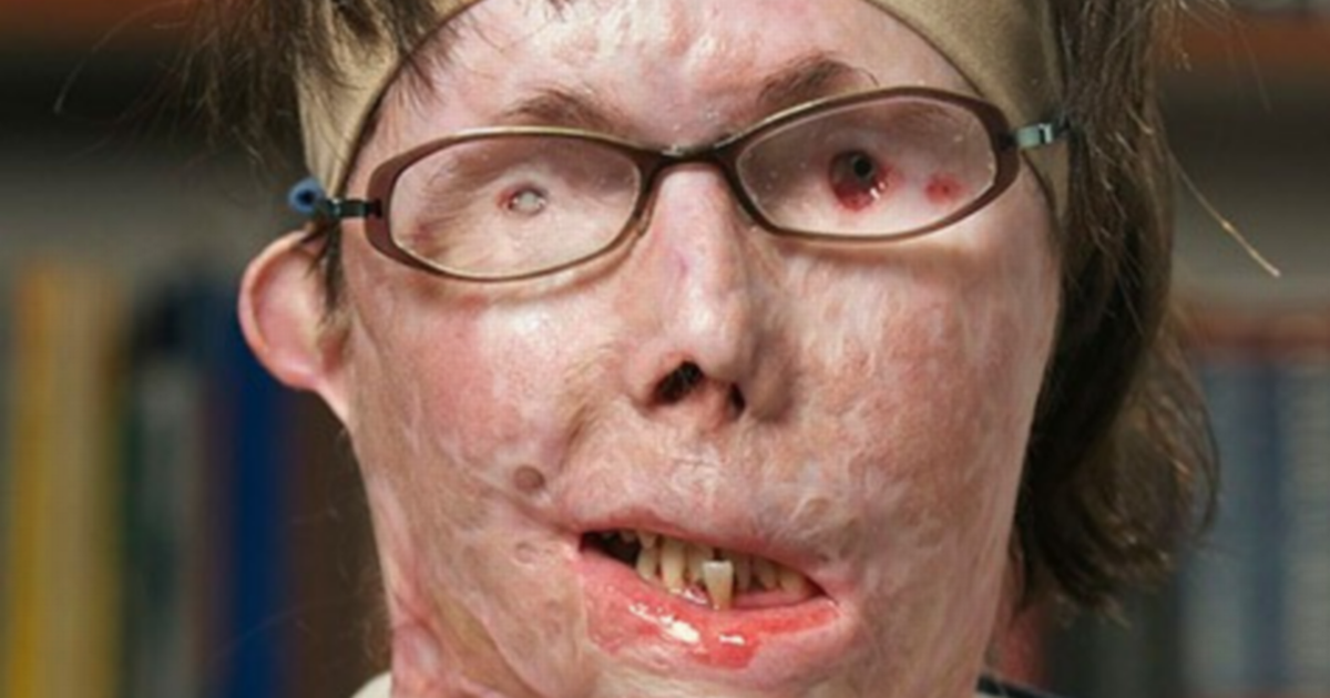 Woman burnt by ex in evil chemical attack undergoes transformation with face transplant