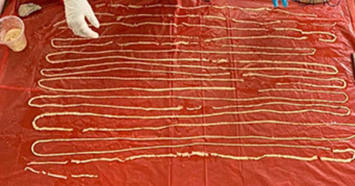 Gigantic 59ft tapeworm emerges from manâ€™s bum after he complained of â€˜flatulenceâ€™